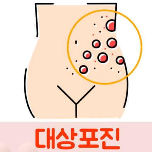 대상포진 초기증상(전염, 원인, 치료법)